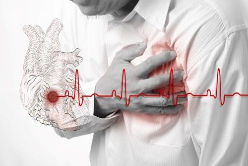 Hjerteinfarkt med EKG